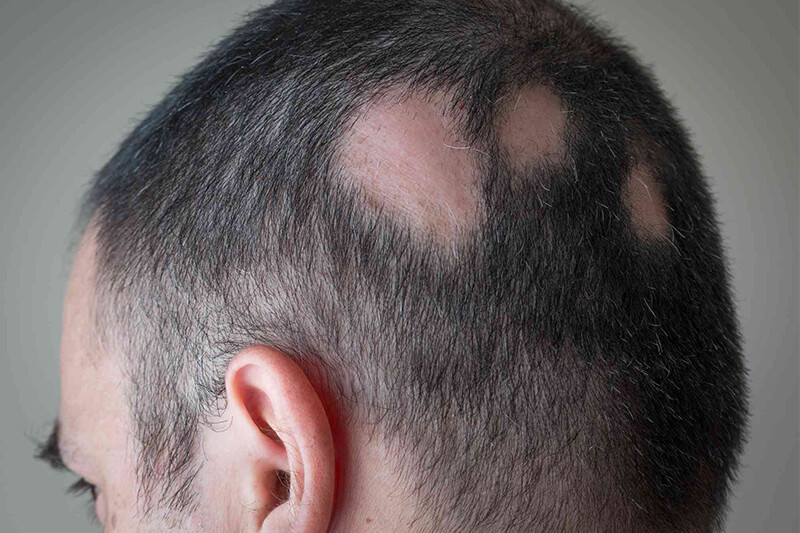 Hair Patch treatment in lucknow